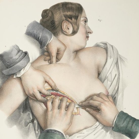 Tokom 20. veka radikalna mastektomija je bila procedura koja se esto koristila kod obolelih od raka/Getty Images
