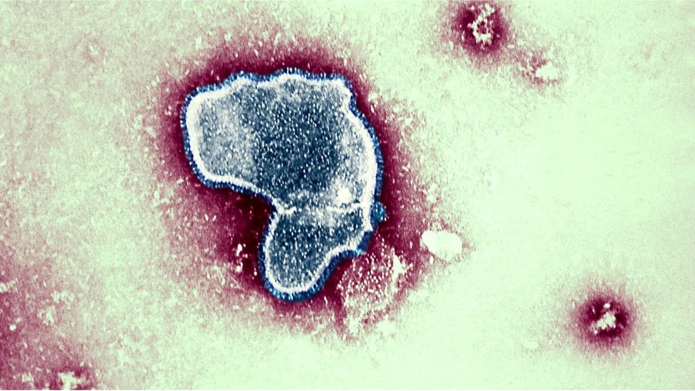 Respiratorni sincicijalni virus (RSV) je uobiajen virus sa jednom RNK koji uzrokuje fuziju zaraenih elija/Getty Images