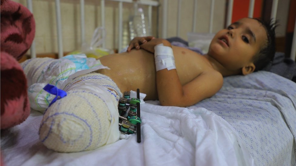 Trogodišnji Ahmed Šabat izgubio je obe noge u eksploziji u Gazi/Mahmud Aki